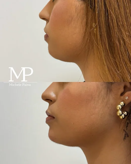 Resultado de estética facial 1
