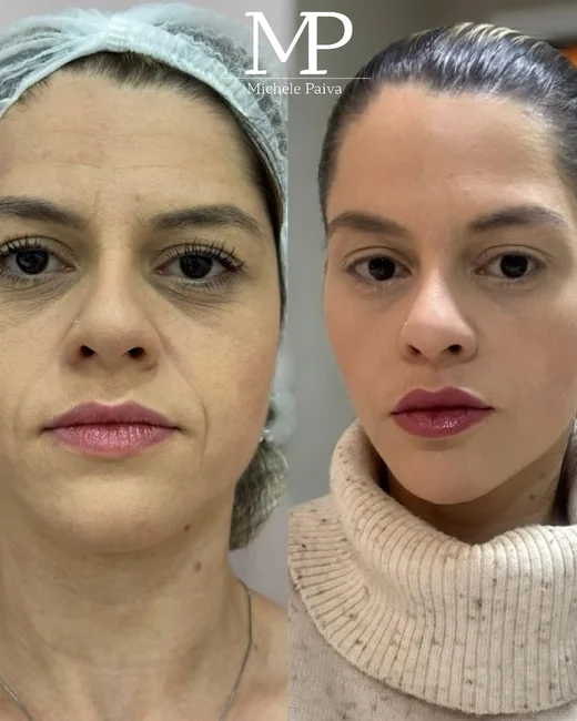 Resultado de estética facial 6
