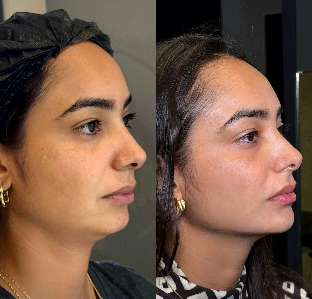 Antes e depois de uma paciente do Protocolo NATURALidade&reg;: antes à esquerda, depois à direita